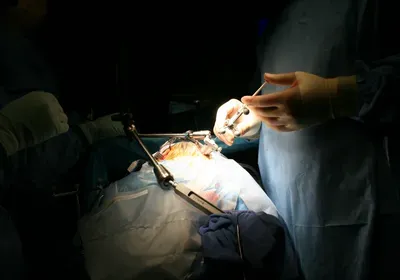 Pelizaeus-Merzbacher disease neural stem cell transplantation